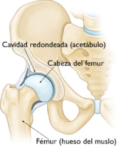 prótesis de cadera