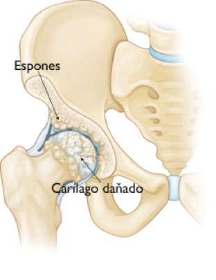 prótesis de cadera