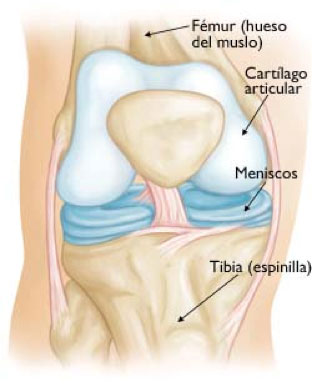 prótesis de rodilla