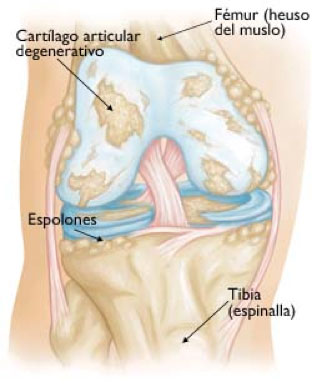 prótesis de rodilla