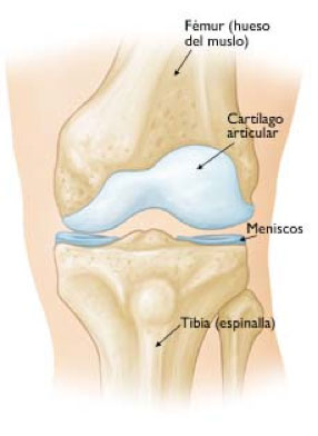 prótesis de rodilla