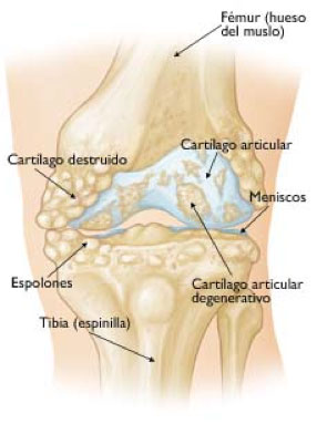 prótesis de rodilla
